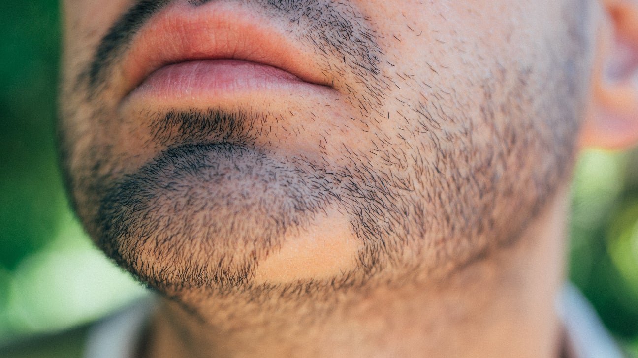 Alopecia areata of the beard, Alopecia areata, Alopecia areata in a female, Alopecia areata in a male