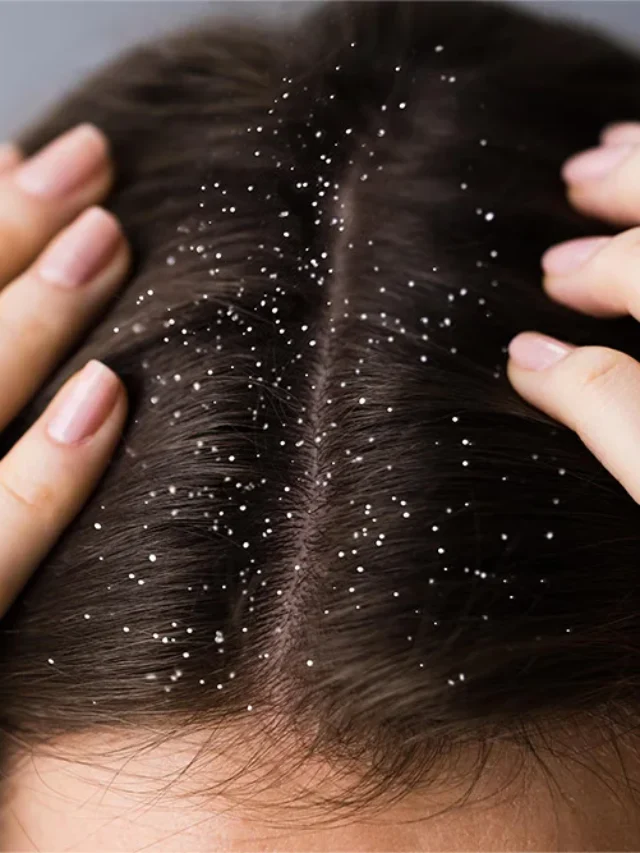 Quick Fix or Myth? Removing Dandruff Overnight